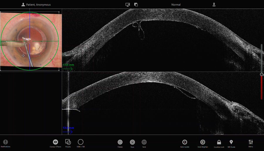 The EnFocus intraoperative OCT clearly showed the Descemet membrane peeling and endothelium. Images provided by Mr. David Anderson