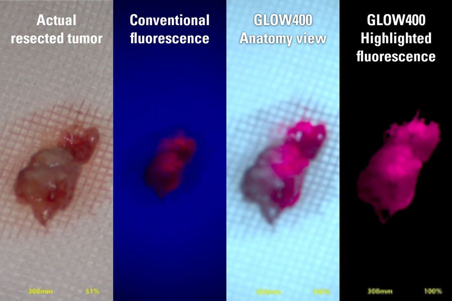 Images of resected tumor with GLOW400 Highlighted Fluorescence view