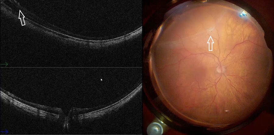 Fig. 6: After removing the PVR, the inferior retina was detached, revealing the subretinal fibrosis (white arrow). The EnFocus intraoperative OCT image shows an area with some subretinal fluid in the inferior edge of the retina (depicted by the arrowhead on the top left).