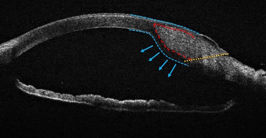 Figure 5: Intraoperative OCT analysis of a sealed incision after hydrosuture. The path of the incision disappears, embedded in the corneal edema. The cornea’s anterior curvature remains regular, while a bulging accompanies the corneal edema of the posterior cornea.