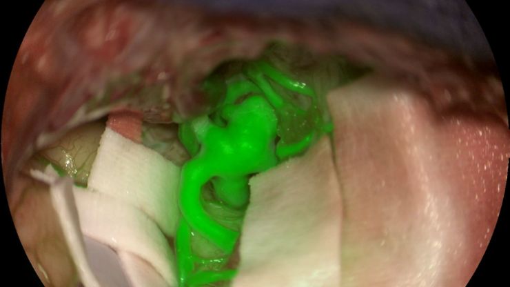 Aneurysm shown with GLOW800 AR fluorescence application. Image courtesy of Prof. Jacques Guyotat, Hôpital Neurologique Pierre Wertheimer, Lyon
