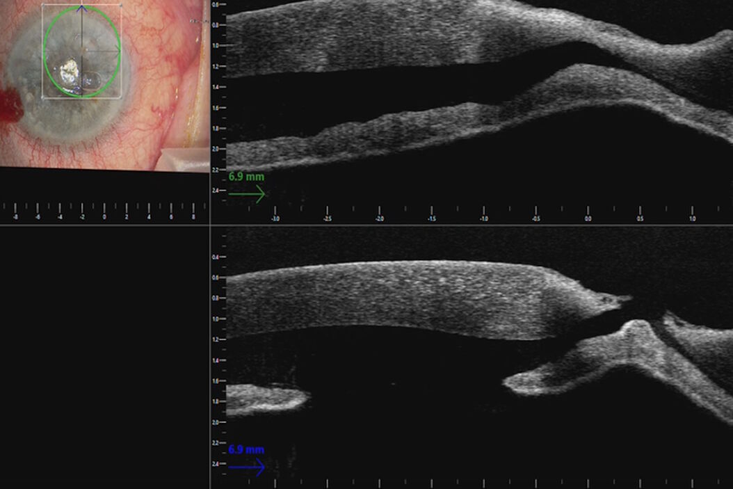 Corneal perforation with iris plugging shown on the intraoperative OCT. Images provided by Mr. David Anderson Corneal_perforation_with_iris_plugging_teaser.jpg