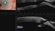 Corneal perforation with iris plugging shown on the intraoperative OCT. Images provided by Mr. David Anderson
