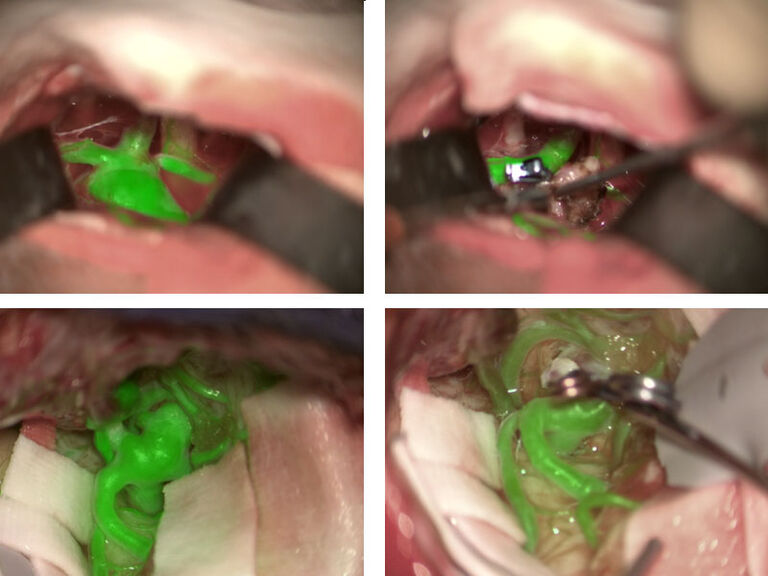 Imagens de cortesia de Cleopatra Charalampaki, MD, PhD, Professora de neurocirurgia, Departamento de Neurocirurgia, Cologne Medical Center, Alemanha.