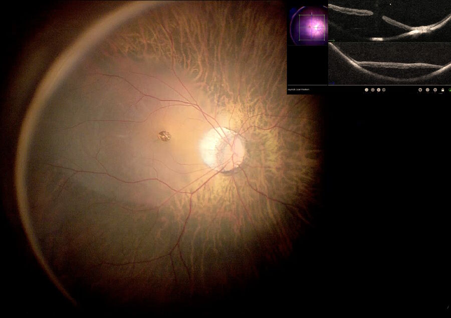Fig. 2: Macular hole in a myopic patient with macular detachment. The intraoperative OCT image is shown on the monitor on the top right, demonstrating macular detachment.