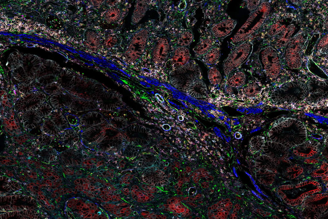 Pancreatic Ductal Adenocarcinoma with 11 cancer immunity and progression biomarkers shown –CD3, CD4, CD20, CD31, CD45, Collagen, HLA1, NaKATPase, PCK26, SMA1, and Vimentin. Pancreatic_Ductal_Adenocarcinoma_11_biomarkers_shown.jpg