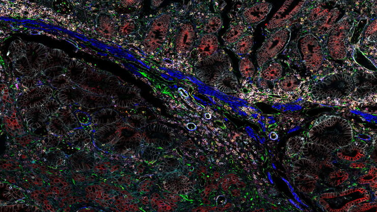 Pancreatic Ductal Adenocarcinoma with 11 cancer immunity and progression biomarkers shown –CD3, CD4, CD20, CD31, CD45, Collagen, HLA1, NaKATPase, PCK26, SMA1, and Vimentin. Pancreatic Ductal Adenocarcinoma with 11 cancer immunity and progression biomarkers shown –CD3, CD4, CD20, CD31, CD45, Collagen, HLA1, NaKATPase, PCK26, SMA1, and Vimentin.