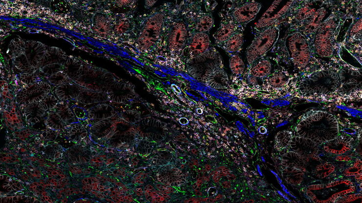 Pancreatic Ductal Adenocarcinoma with 11 cancer immunity and progression biomarkers shown –CD3, CD4, CD20, CD31, CD45, Collagen, HLA1, NaKATPase, PCK26, SMA1, and Vimentin.