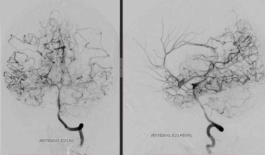 Left vertebral angiography  (AP and lateral views)  showing the irrigation  of the carotid territory  from posterior circulation  through a patent posterior  communicating artery.