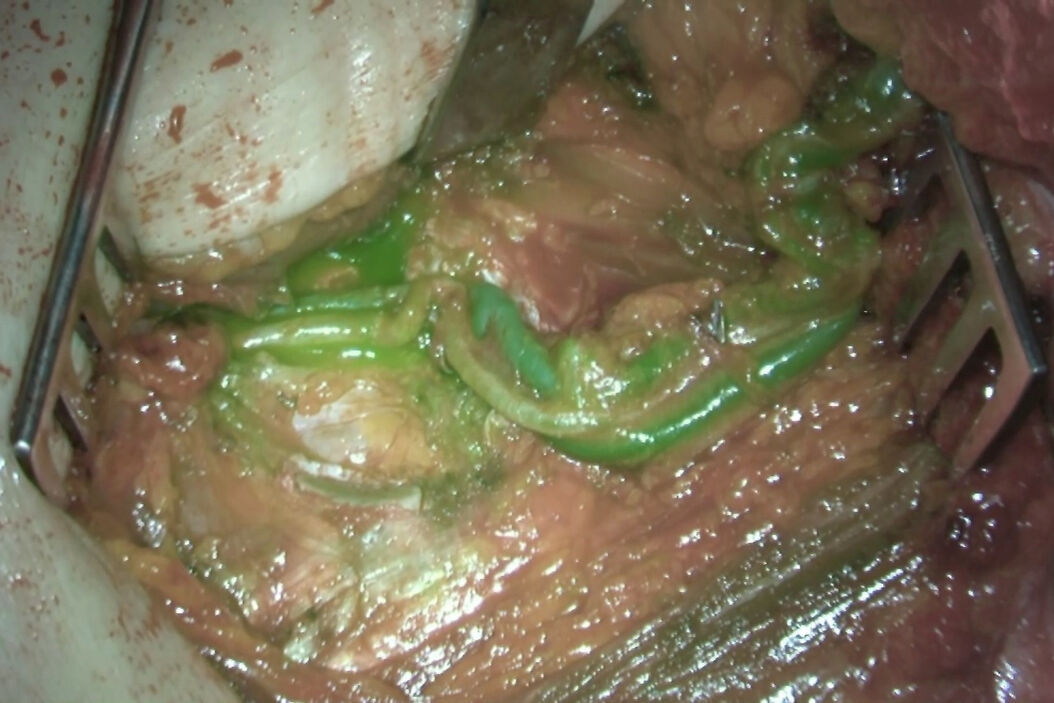 GLOW800, a patented Leica technology, used by Dr. Harold Chatel to check free flap vascularization after anastomoses as part of an immediate breast reconstruction. Immediate_Breast_Reconstruction_Benefits_of_GLOW800_Augmented_Reality_Teaser.jpeg