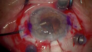 Intraoperative OCT-assisted complex cataract surgery. Image courtesy of Dr. Ozana Moraru. 