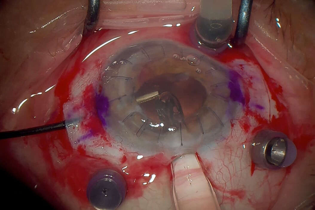 Intraoperative OCT-assisted complex cataract surgery. Image courtesy of Dr. Ozana Moraru.  Secondary_IOL_implantation_in_a_transplanted_eye_01.jpg
