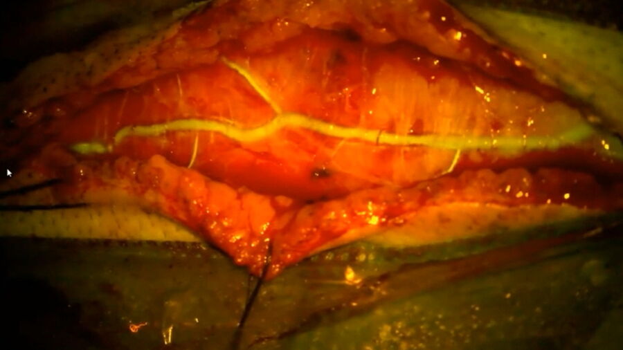 Use of the Leica FL560 fluorescein fluorescence module during bypass surgery.