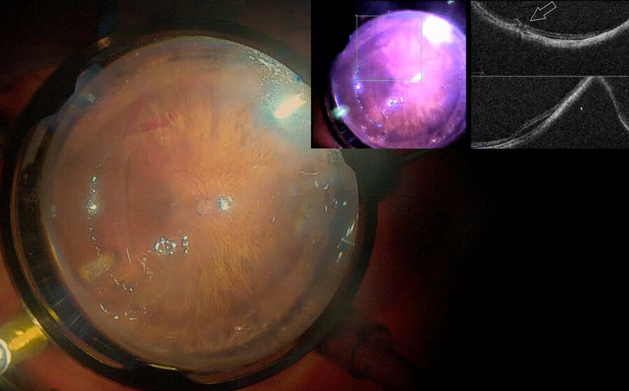 Fig. 8: The same patient as depicted in Figs. 5 and 6. Attached retina after removing subretinal fibrosis band. EnFocus intraoperative OCT confirmed the retinotomy carried out using an endodiathermy probe (depicted by the arrow).