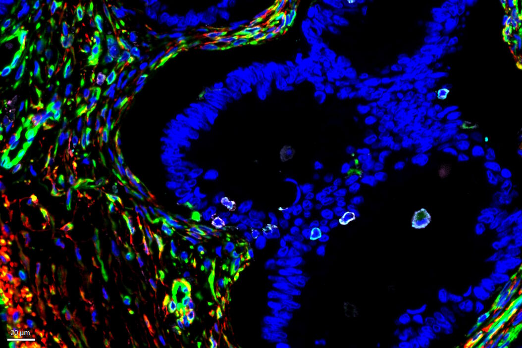  Cell_populations_identified_in_mucinous_cystadenocarcinoma_of_ovary.jpg