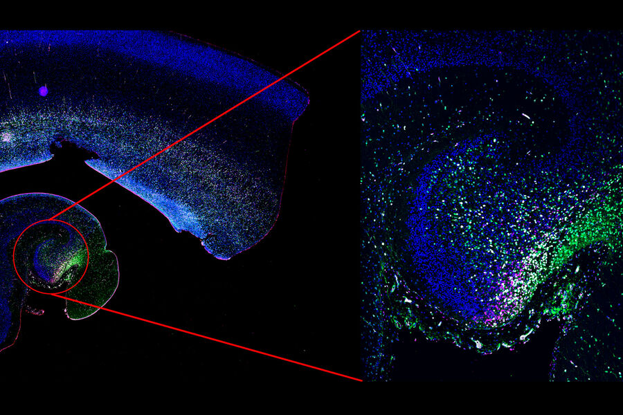 ヒト海馬。発達中のヒトの脳における、Ki67（赤）、MCM2（マゼンタ）、SOX2（緑）が増殖するニューロン前駆細胞。左：蛍光観察モードで高速取得したOverview画像。右：共焦点モードで取得した高解像度画像。画像提供：Piero Rigo, PhD Student at the Francis Crick Institute, London, UK.