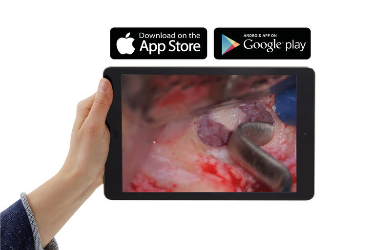 Inviate immagini e video in streaming dal microscopio chirurgico M320 per la formazione professionale a dispositivi mobili tramite l'app Leica View. Questa immagine odontoiatrica mostra un rialzo del seno mascellare ("sinus lift"), immagine per gentile concessione del Dott Fabio Gorni, Milano.
