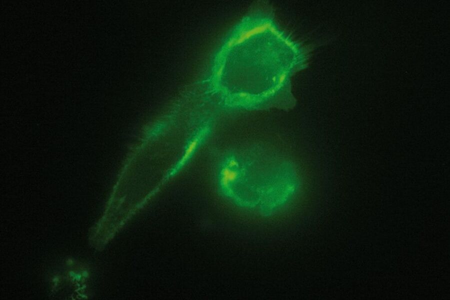 Widefield fluorescence image of brest carcinoma tumor cells expressing GFP tagged cell adhesion Molecule CD44 that is expressed on the cell membrane.