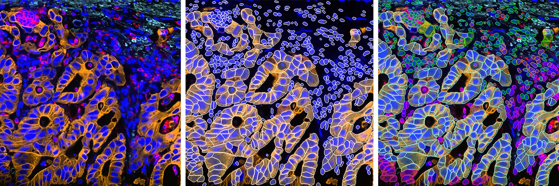 2D-Schnitt eines mit 30 Markern gefärbten Darmkrebsgewebes, aufgenommen mit einem Cell DIVE System.