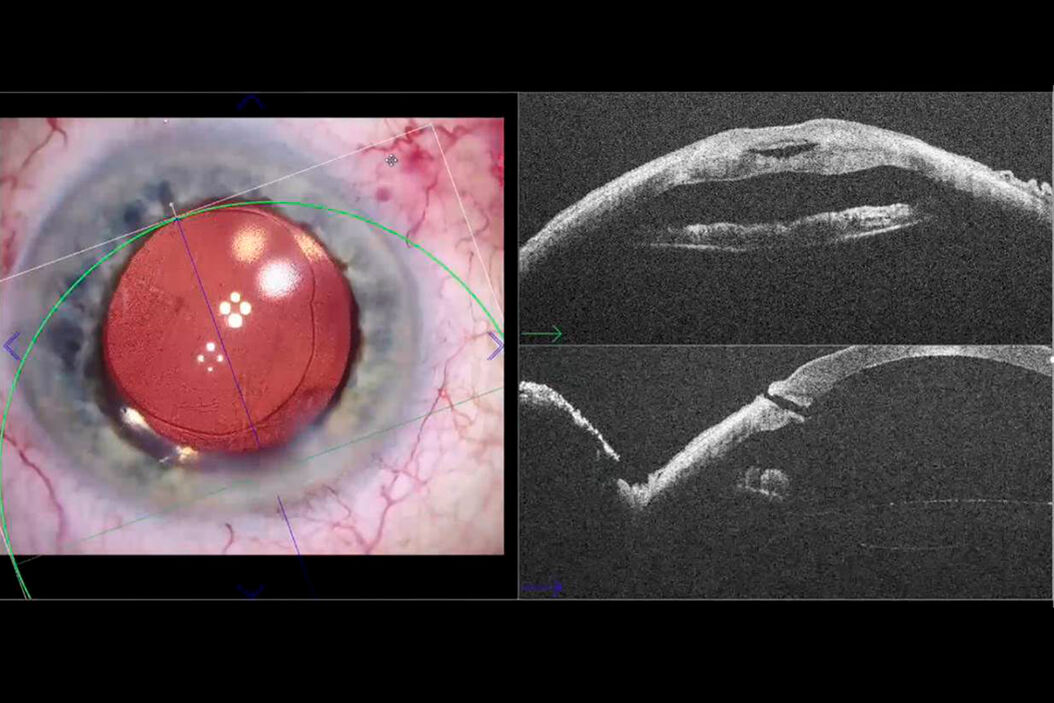  Cataract_Incision_Analysis_Using_EnFocus_Teaser.jpg