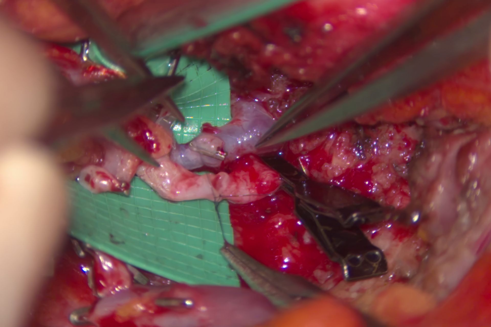 High-resolution 3D optics [JB19.1]with enhanced depth of field [JB20.1]allow surgeons to clearly identify and safely dissect perforators and perform delicate vessel anastomoses. Mr Dariush Nikkhah. DIEP surgery London. 