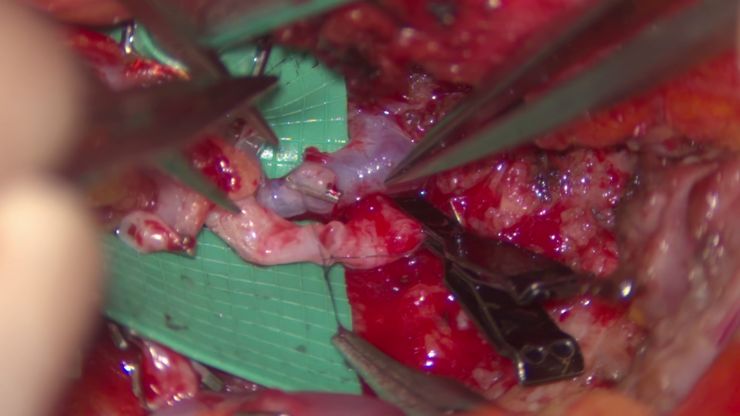 High-resolution 3D optics [JB19.1]with enhanced depth of field [JB20.1]allow surgeons to clearly identify and safely dissect perforators and perform delicate vessel anastomoses. Mr Dariush Nikkhah. DIEP surgery London. 