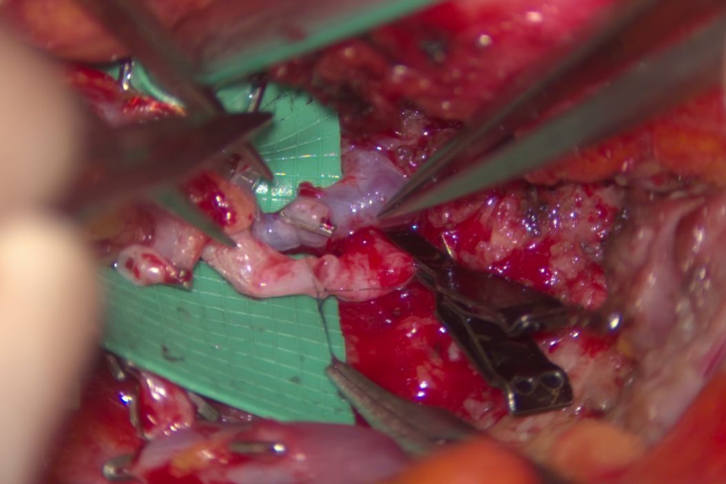 High-resolution 3D optics [JB19.1]with enhanced depth of field [JB20.1]allow surgeons to clearly identify and safely dissect perforators and perform delicate vessel anastomoses. Mr Dariush Nikkhah. DIEP surgery London.  Bilateral_DIEP_flap_breast_reconstruction_Ghali_and_Nikkhah.jpg
