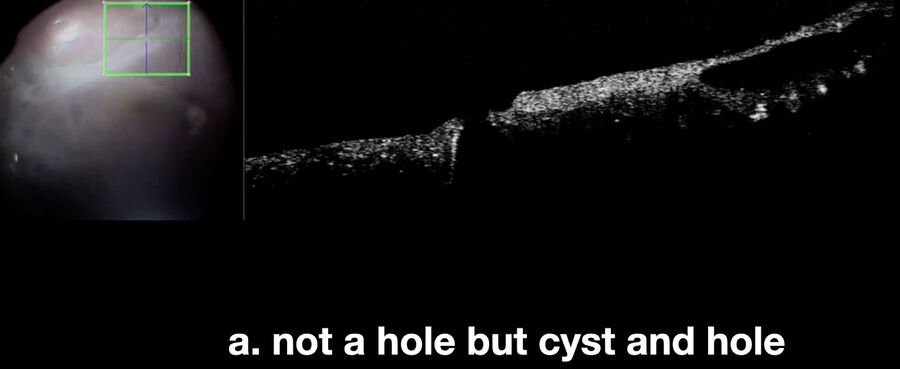 Intraoperative OCT shows that point “a” is a cyst located in close proximity to a hole.