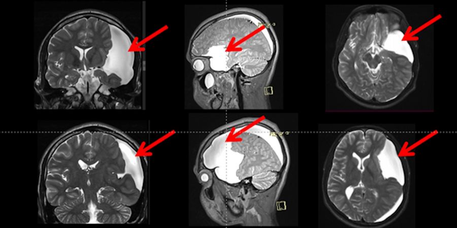 T2 weighted MRI showed a large arachnoid cyst (red arrows), Galassi III with a hyper-signal compared to the brain, and iso-signal when compared to the cerebrospinal fluid inside the ventricles. This cyst is compressing the adjacent brain and is not communicating with the Sylvian, carotid, and optic-Chiasmatic cisterns)