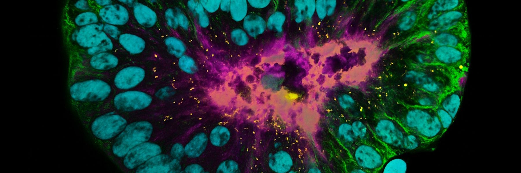 Patient-derived pulmonary neuroendocrine tumor organoid labelled with DAPI (cyan), phalloidin (magenta), beta-catenin (green), and ZO-1 (yellow). Sample courtesy of Marina Cuenca and Heleen Jungen, Talya Dayton lab, EMBL Barcelona.