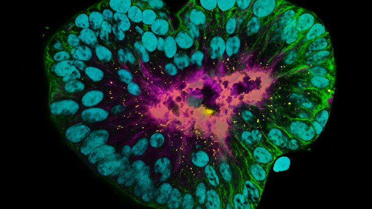 Patient-derived pulmonary neuroendocrine tumor organoid labelled with DAPI (cyan), phalloidin (magenta), beta-catenin (green), and ZO-1 (yellow). Sample courtesy of Marina Cuenca and Heleen Jungen, Talya Dayton lab, EMBL Barcelona.