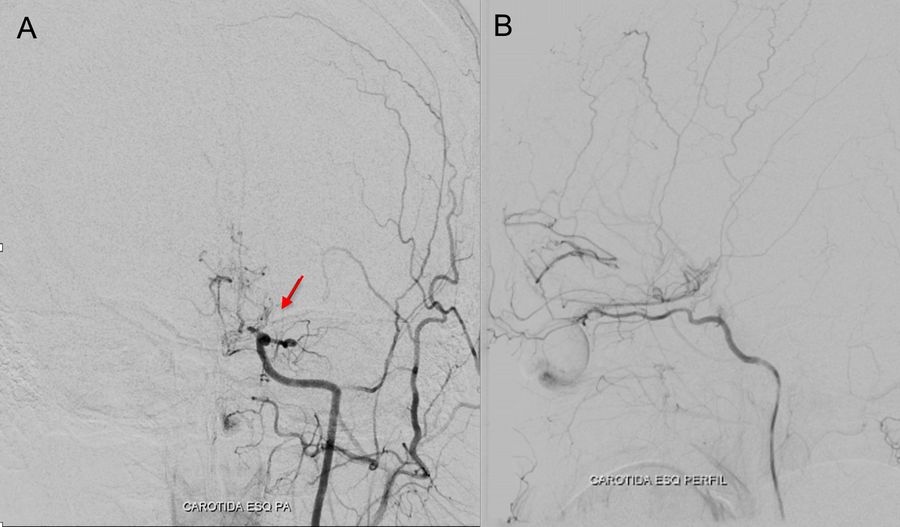 A: Left common carotid angiography (AP view) showing stenosis of the supraclinoid segment of the internal carotid artery, as well asproximal stenosis of the anterior and  middle cerebral arteries and collateral vessels as a “puff of smoke” which are characteristic findings in the context of moyamoya disease (Scott, R. M., & Smith, E. R. (2009)). B: Image of the left external carotid artery showing the collateral circulation from the internal maxillary artery to the ipsilateral carotid territory.