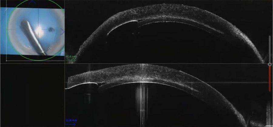 Throughout the dissection, the intraoperative OCT image is always in focus. There is no need to stop and realign the focus during the procedure. Images provided by Mr. David Anderson.