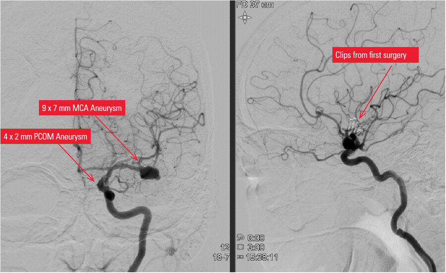 Pre-Operative DSA showing the unruptured aeurysms and the clips from the prior surgery.