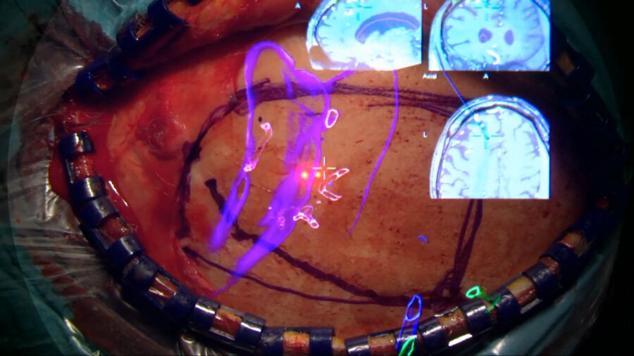 AVM Surgery using Augmented Reality. Image courtesy of Prof. Philippe Bijlenga