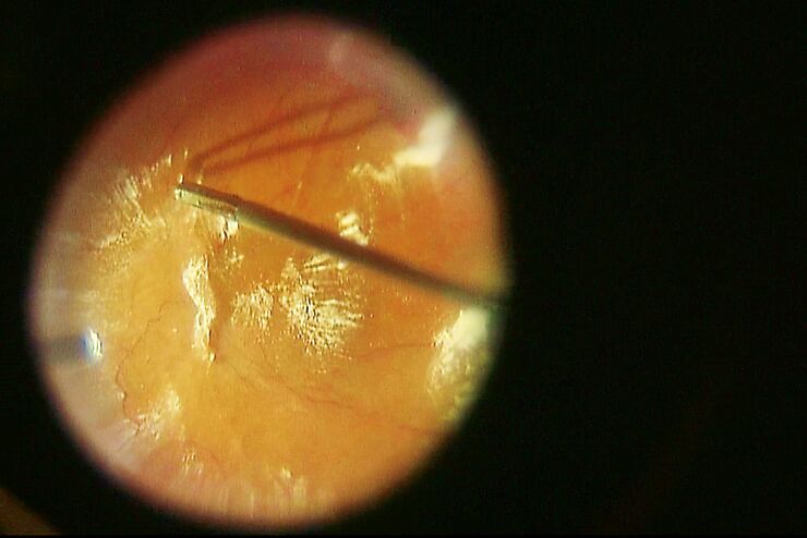 Integração de acessórios da retina