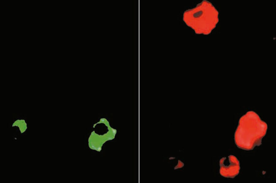 Bone marrow cells stained with an anti-kappa TRITC conjugate and an anti-IgG FITC conjugate. Epi-illmination with narrow-band green and blue light resulting in red fluorescence of cells containing TRITC and green fluorescence of cells containing FITC. Some cells contain both FITC and TRITC.