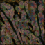 Multiplex cell detection in a colon adenocarcinoma tissue section with NAK, PanCK, and EPCAM channels using Segment by Example.