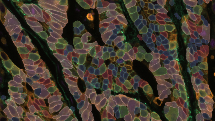 Multiplex cell detection in a colon adenocarcinoma tissue section with NAK, PanCK, and EPCAM channels using Segment by Example.