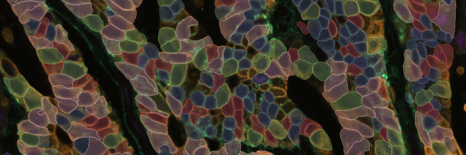 Multiplex cell detection in a colon adenocarcinoma tissue section with NAK, PanCK, and EPCAM channels using Segment by Example.