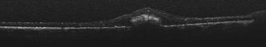 Intraoperative OCT enabled the visualization of the white lobule, confirming that there was no recurrence of the tumor. Images provided by Prof. Nikolaos Bechrakis.