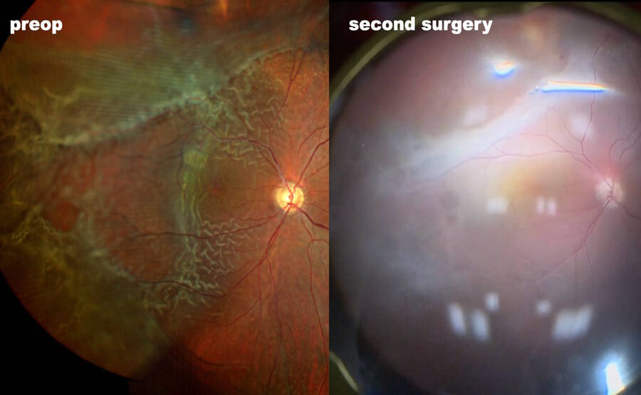 A case of retinal detachment associated with congenital retinoschisis. The patient underwent two surgeries.
