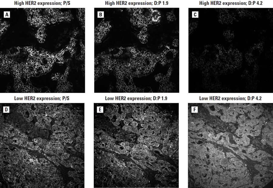 Figure 4: Antibody sensitivity and specificity following conjugation in invasive ductal carcinoma. The effects of direct conjugation of Cy5 dye to a HER2 antibody are assessed in a sample with strong HER2 expression (A–C) and one with weak expression (D–F) compared to HER2 primary/secondary antibody staining (A, D). A dye-to-protein ratio (D:P) of 1.9 is more sensitive (B, E) and specific (E) than a D:P of 4.2 (C, F).
