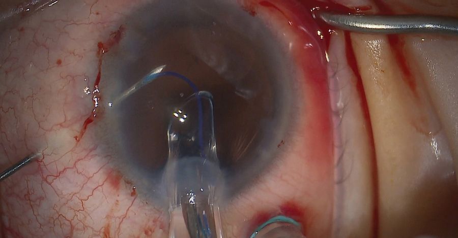 Placement of the intraocular lens, using a 27-guage needle to dock the haptic to avoid dropping the lens. Image courtesy of Arsham Sheybani, MD, Washington University School of Medicine.