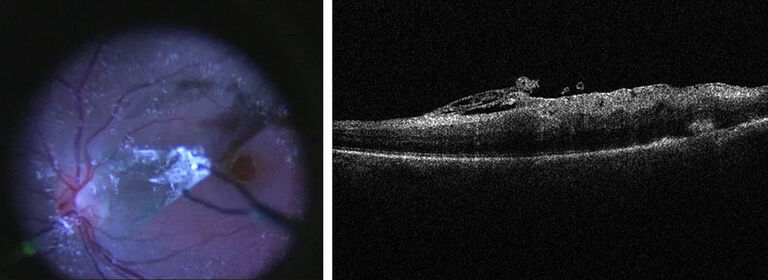 Microscope view of retina (left) supplemented with EnFocus OCT (right) to visualize membrane layers during peeling. OCT image courtesy of Seenu M. Hariprasad, MD, Chicago, USA.