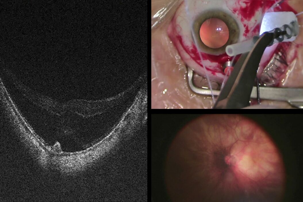  Moving_to_Routine_Use_of_Intraoperational_optical_OCT_Teaser.jpg