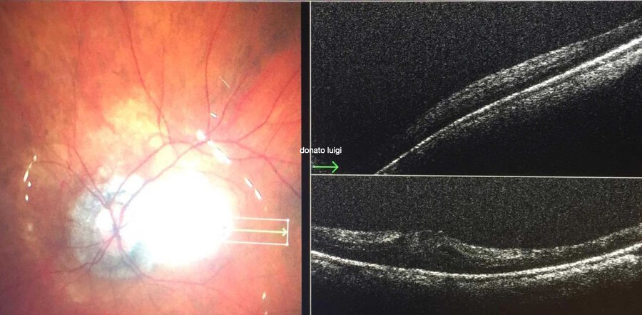 Vitrectomy treatment to repair a macular hole. The intraoperative OCT view shows the good position of the ILM flap covering the hole, even under air as tamponade.