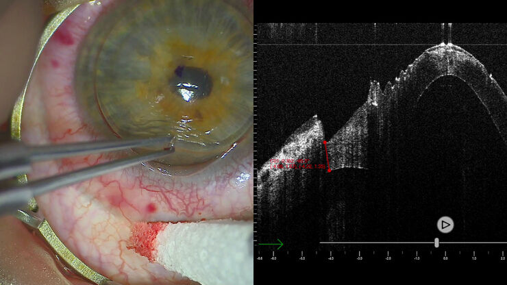 Measurement during corneal lamellar transplant surgery, Dr. Enrico Bertelli, Bolzano, Italy