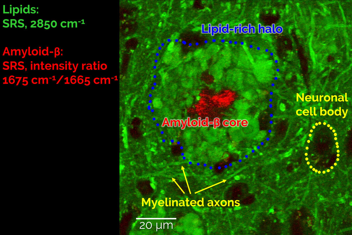 Stimulated Raman Scattering Microscopy Probes Neurodegenerative Disease ...