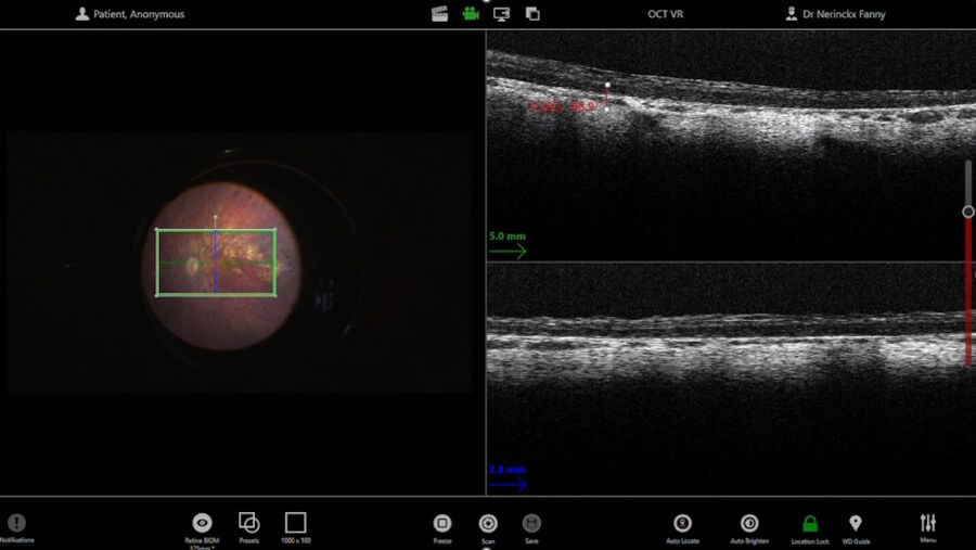 Figure 4: Utilize intraoperative OCT to measure retinal thickness.